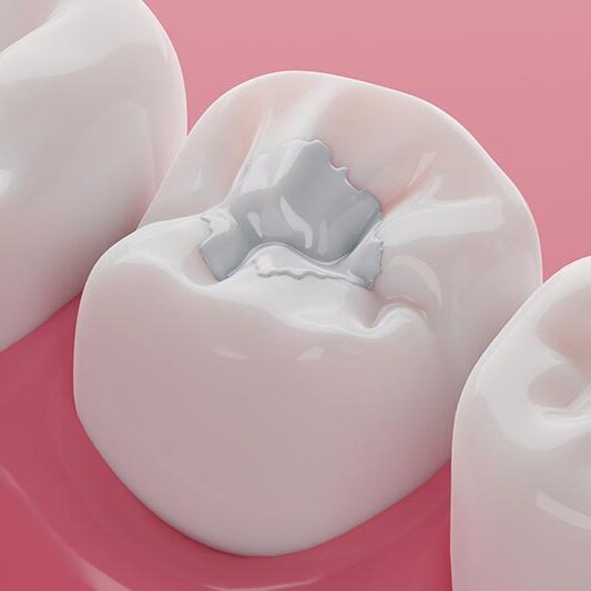 dental fillings Render of filling in molar