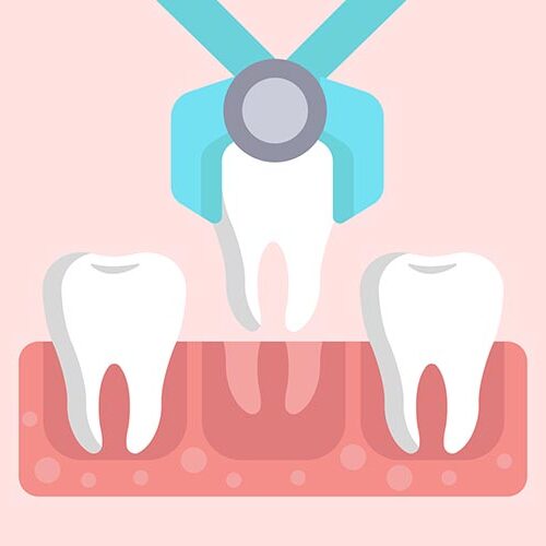 tooth extraction illustration of tooth bein pulled