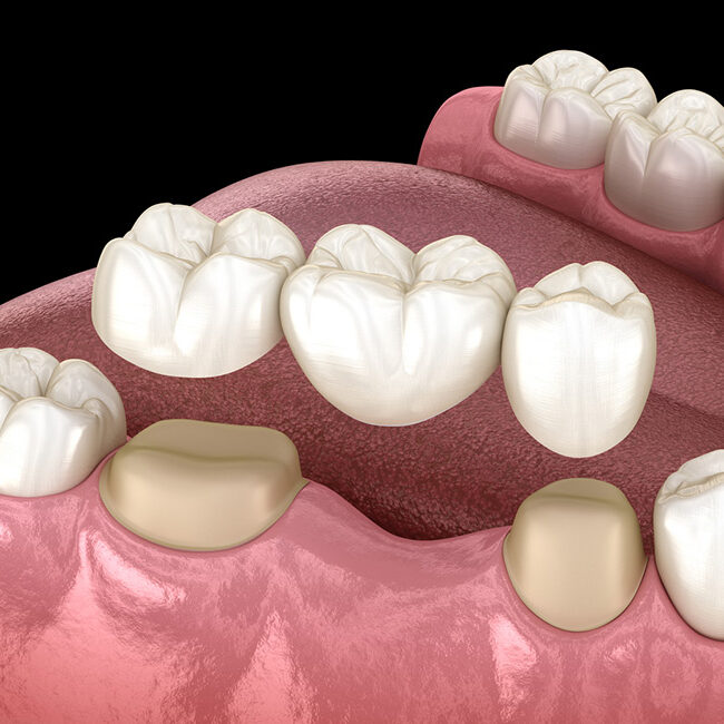 tooth bridge render of a dental bridge